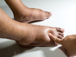 112496525-Prot-Tachapanit-Dreamstime-INP-Instituut-voor-Neuropathische-Pijn crps pijn