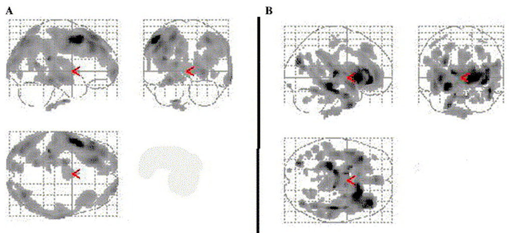 Diaschisis-INP