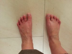 crps-yl-INP-Instituut-voor-Neuropathische-Pijn posttraumatische dystrofie crps