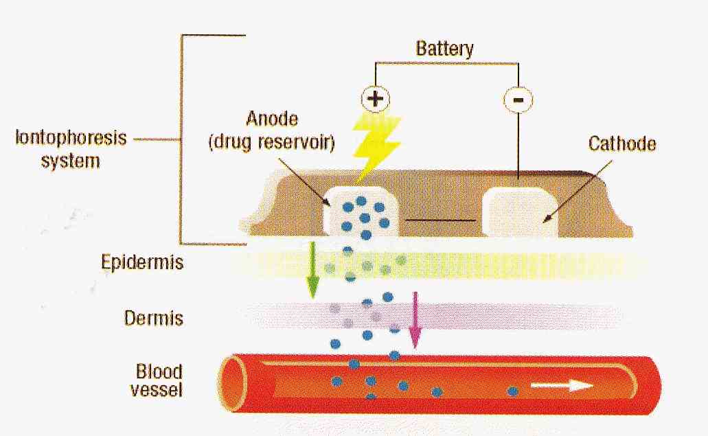 iontophoresis.jpg