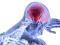 Wat is centrale neuropathische pijn (CNP)?