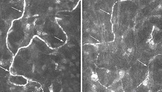 retina inp
