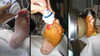 shock_wave_therapy-inp