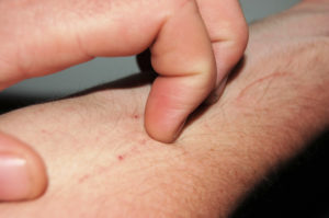 wikimedia-Itch_02-INP psoriasis