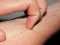 Psoriasis: a new innovative approach